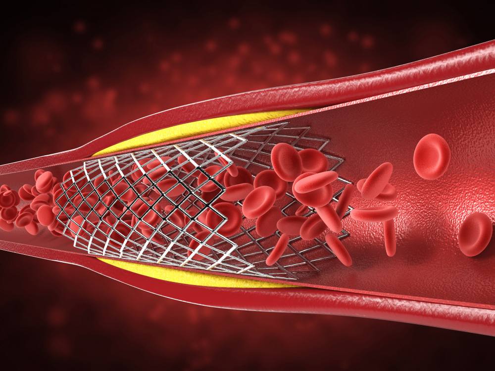 Procedure of Balloon Angioplasty